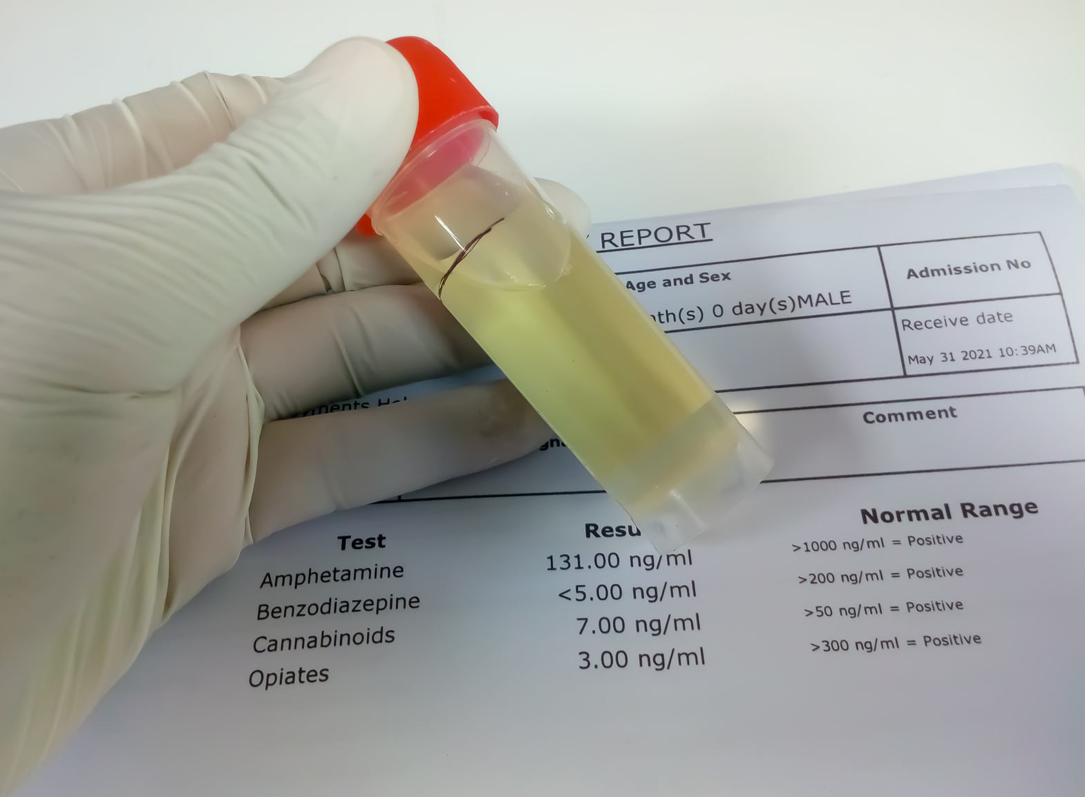 Scientist hold urine sample for drug test with laboratory report on background. Amphetamine, opiates, Benzodiazepine, Cannabis.